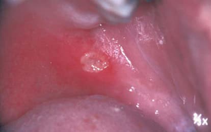 Aftos stomatitis