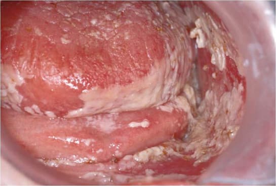 Candidiasis oralis