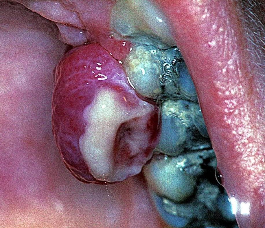 Granuloma pyogenicum