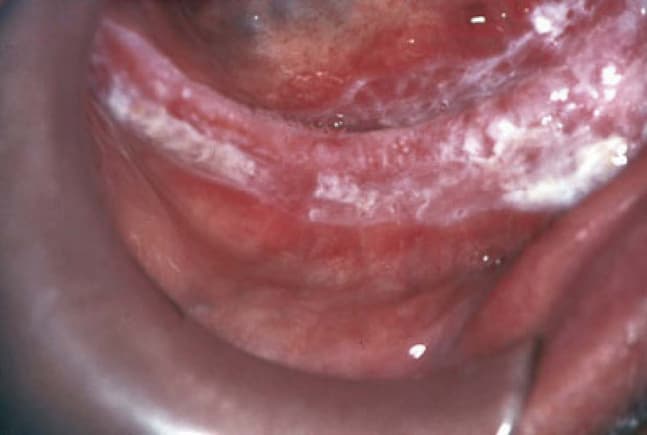 Leukoplakia mucosae oris